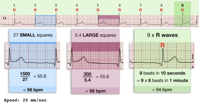 Cara menghitung hr ekg