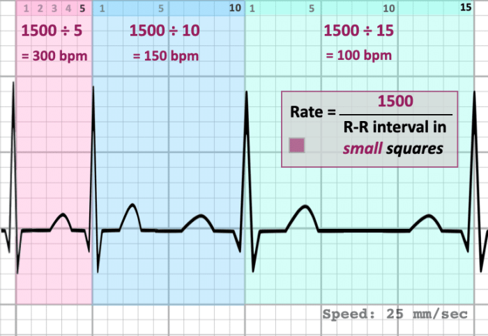 Cara menghitung heart rate ekg ireguler