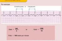 Cara menghitung heart rate ekg ireguler