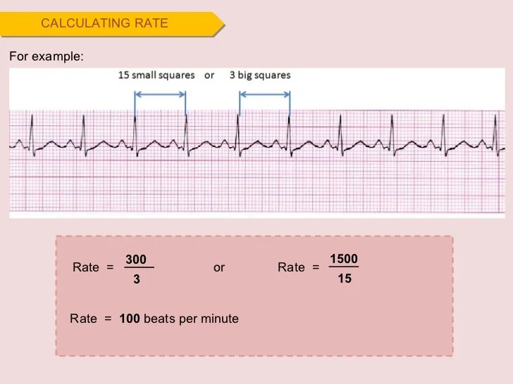 Cara menghitung heart rate ekg ireguler