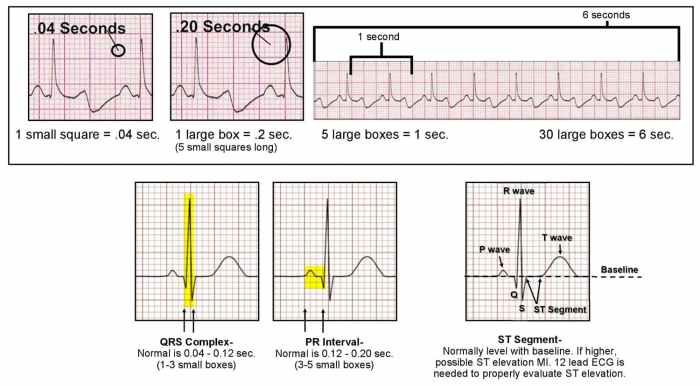 Ecg ekg interpretation lead wave nursing normal heart strips cardiac interpret waveform rhythm electrocardiogram nurses nurse reading placement segment rhythms