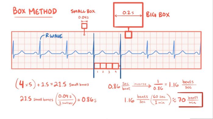 Cara menghitung heart rate ekg ireguler